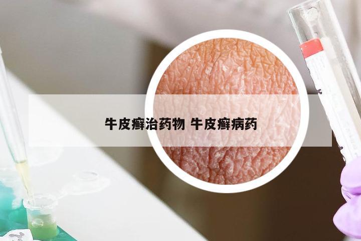 牛皮癣治药物 牛皮癣病药