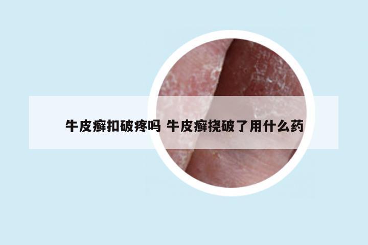 牛皮癣扣破疼吗 牛皮癣挠破了用什么药