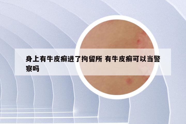 身上有牛皮癣进了拘留所 有牛皮癣可以当警察吗