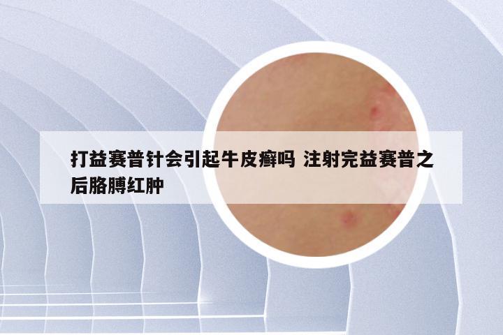 打益赛普针会引起牛皮癣吗 注射完益赛普之后胳膊红肿