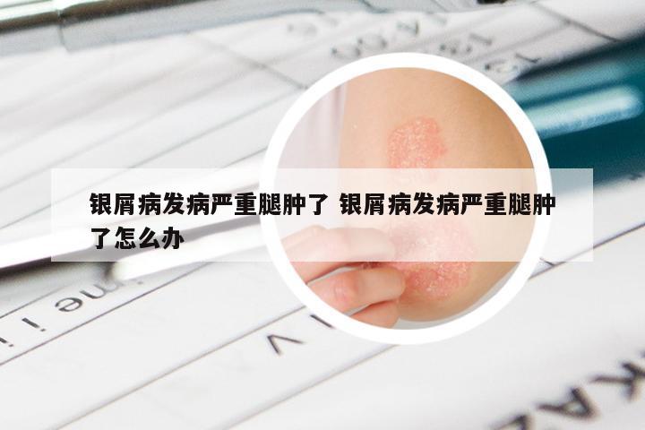 银屑病发病严重腿肿了 银屑病发病严重腿肿了怎么办