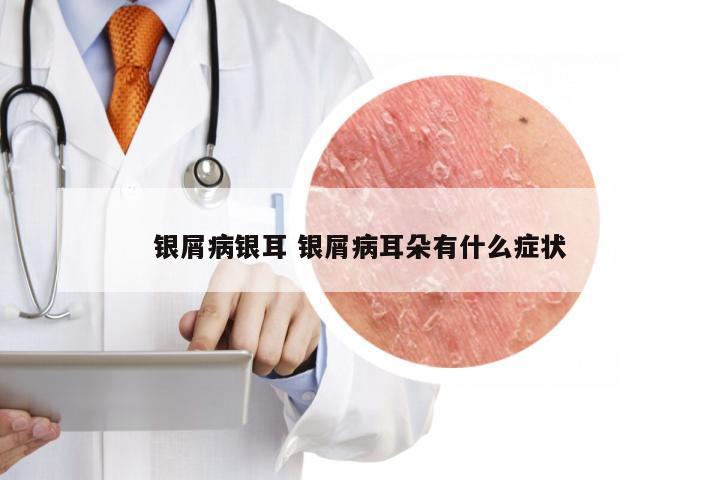 银屑病银耳 银屑病耳朵有什么症状