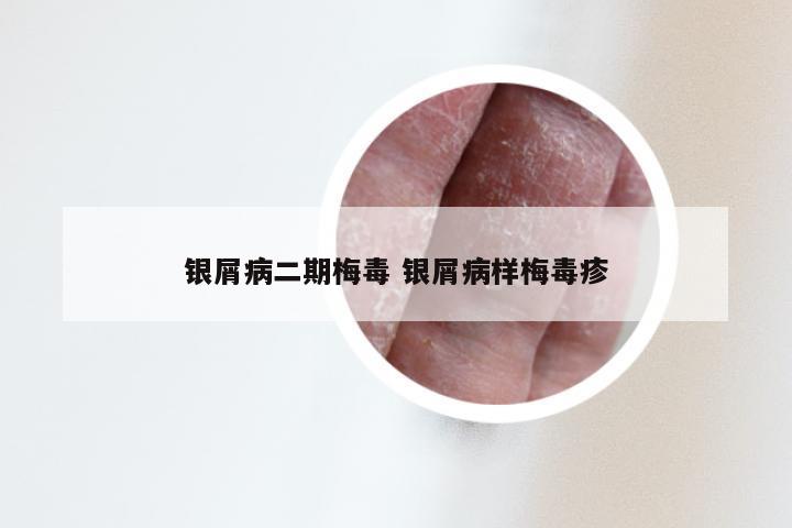 银屑病二期梅毒 银屑病样梅毒疹