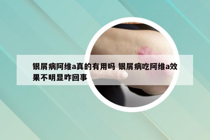 银屑病阿维a真的有用吗 银屑病吃阿维a效果不明显咋回事