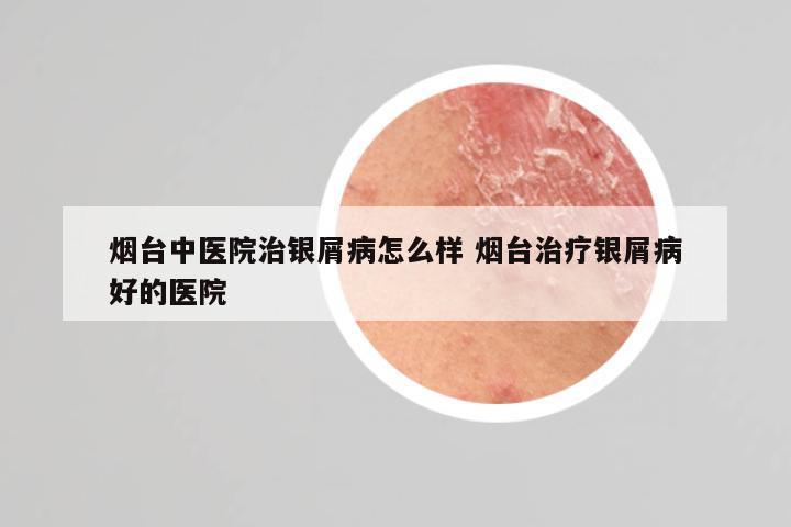 烟台中医院治银屑病怎么样 烟台治疗银屑病好的医院