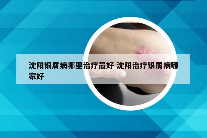 沈阳银屑病哪里治疗最好 沈阳治疗银屑病哪家好