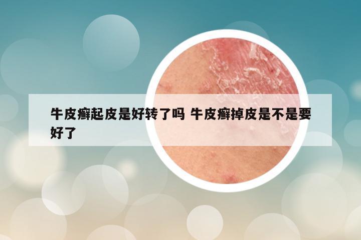牛皮癣起皮是好转了吗 牛皮癣掉皮是不是要好了