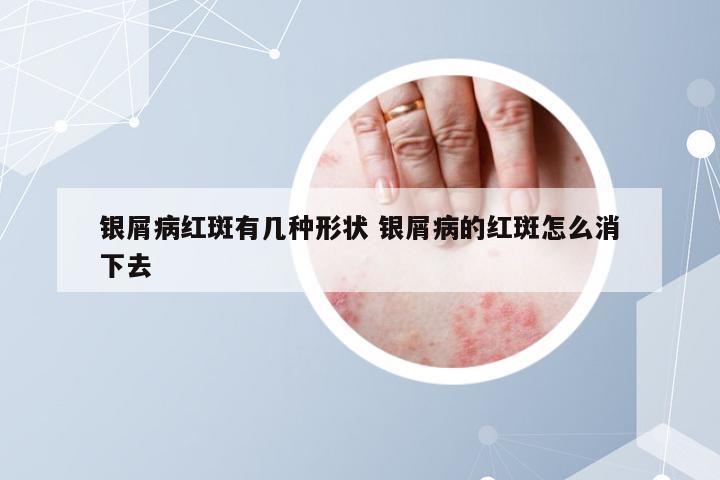 银屑病红斑有几种形状 银屑病的红斑怎么消下去