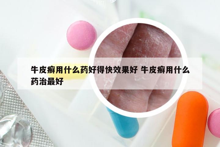 牛皮癣用什么药好得快效果好 牛皮癣用什么药治最好