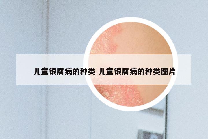 儿童银屑病的种类 儿童银屑病的种类图片