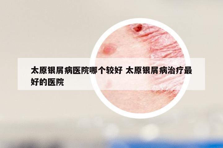 太原银屑病医院哪个较好 太原银屑病治疗最好的医院