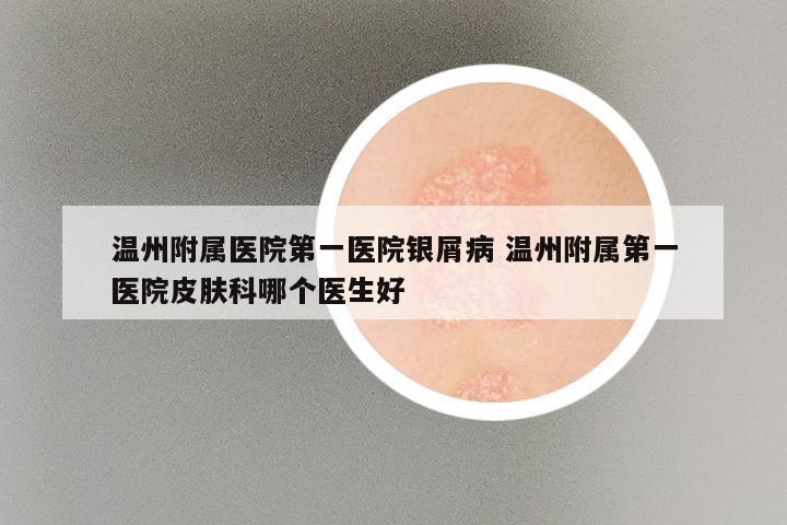 温州附属医院第一医院银屑病 温州附属第一医院皮肤科哪个医生好