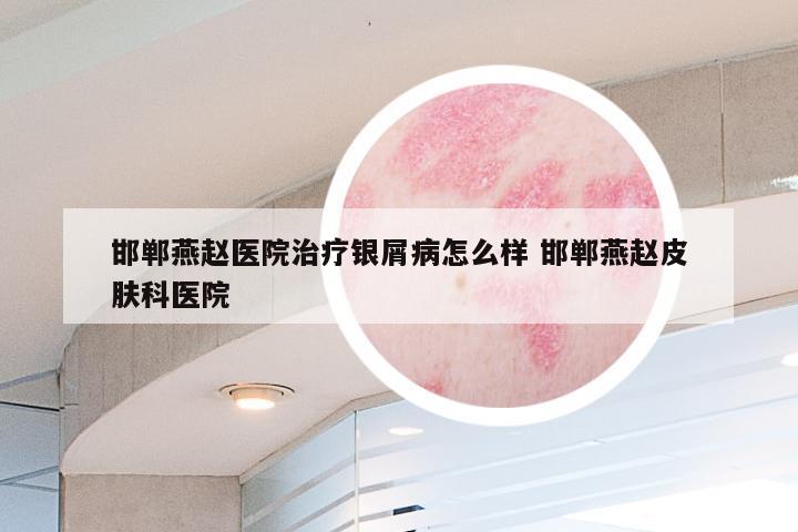 邯郸燕赵医院治疗银屑病怎么样 邯郸燕赵皮肤科医院