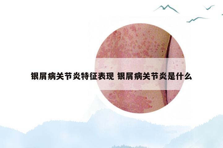 银屑病关节炎特征表现 银屑病关节炎是什么