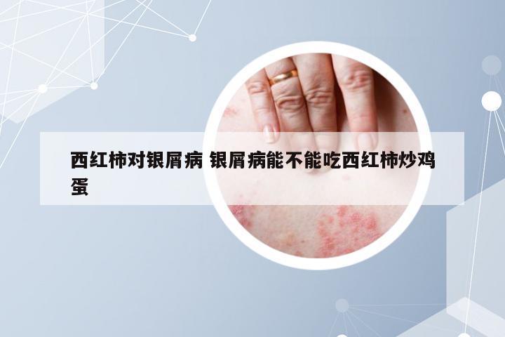 西红柿对银屑病 银屑病能不能吃西红柿炒鸡蛋