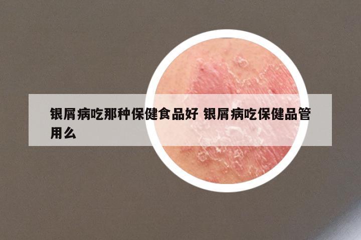 银屑病吃那种保健食品好 银屑病吃保健品管用么
