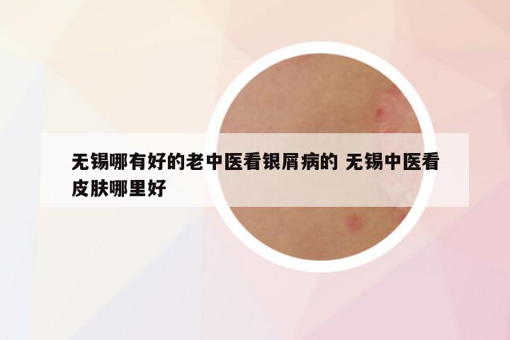 无锡哪有好的老中医看银屑病的 无锡中医看皮肤哪里好