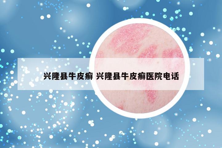 兴隆县牛皮癣 兴隆县牛皮癣医院电话