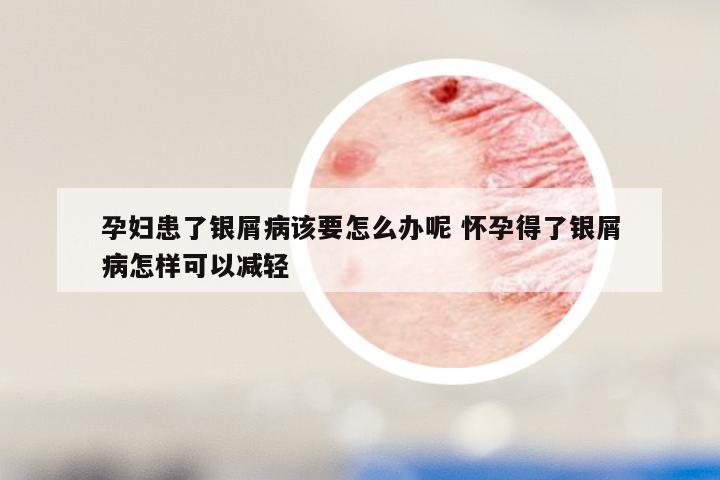 孕妇患了银屑病该要怎么办呢 怀孕得了银屑病怎样可以减轻