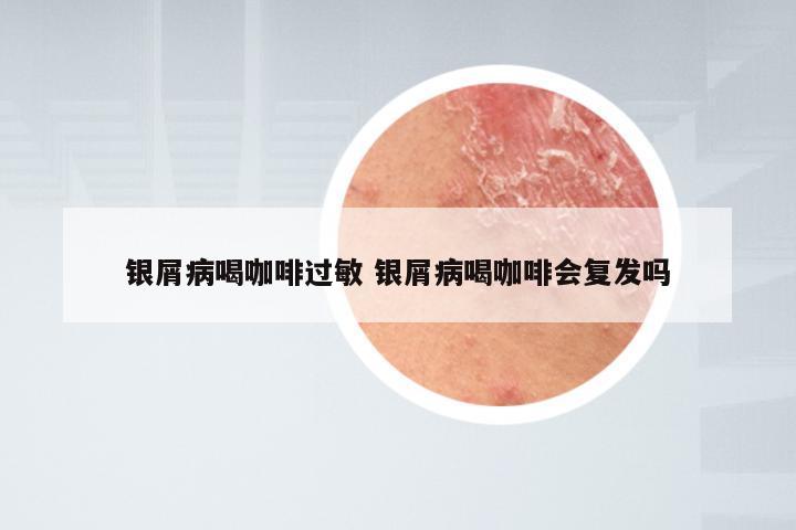 银屑病喝咖啡过敏 银屑病喝咖啡会复发吗