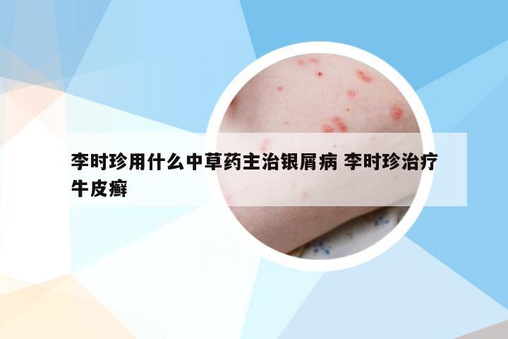 李时珍用什么中草药主治银屑病 李时珍治疗牛皮癣