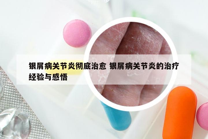 银屑病关节炎彻底治愈 银屑病关节炎的治疗经验与感悟