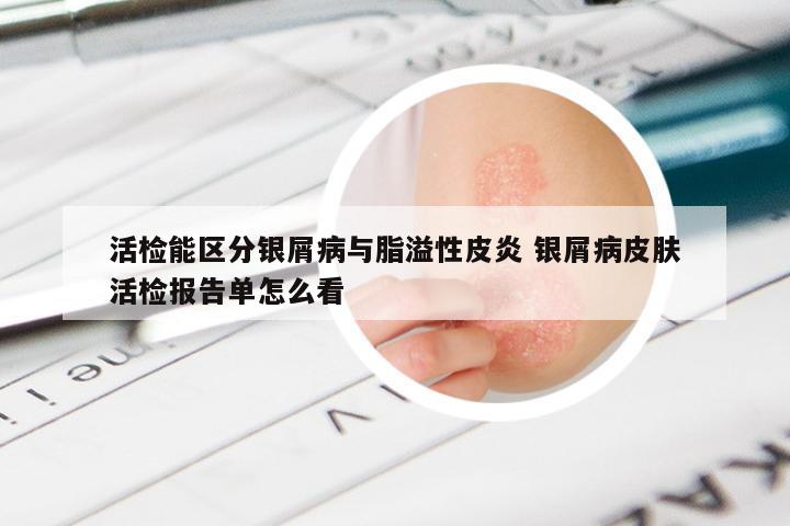 活检能区分银屑病与脂溢性皮炎 银屑病皮肤活检报告单怎么看