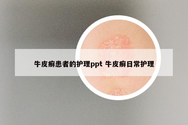 牛皮癣患者的护理ppt 牛皮癣日常护理