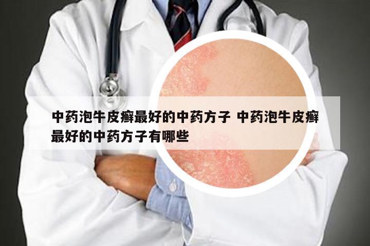 中药泡牛皮癣最好的中药方子 中药泡牛皮癣最好的中药方子有哪些