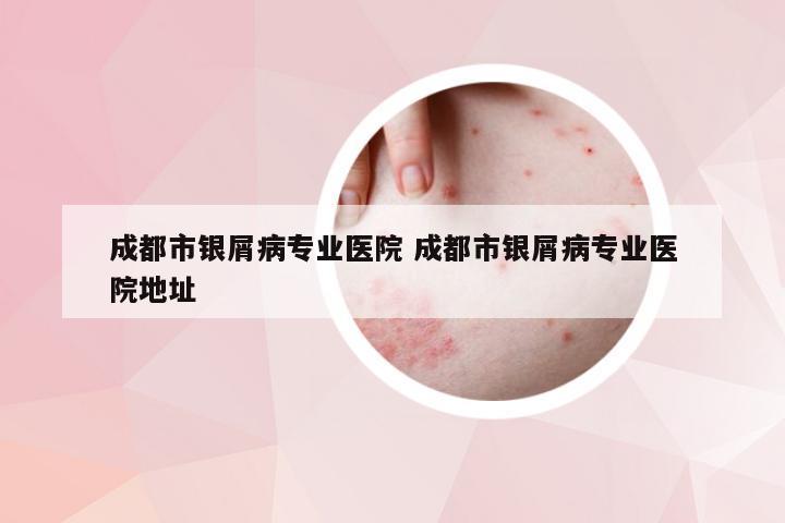 成都市银屑病专业医院 成都市银屑病专业医院地址