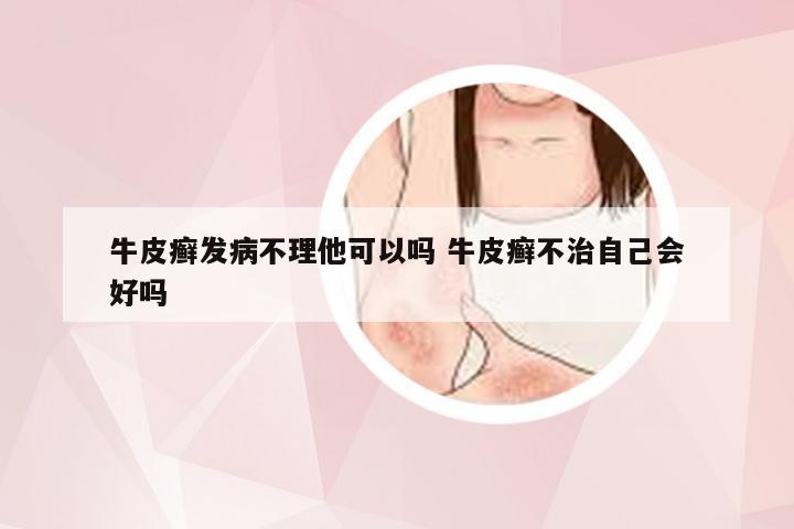 牛皮癣发病不理他可以吗 牛皮癣不治自己会好吗