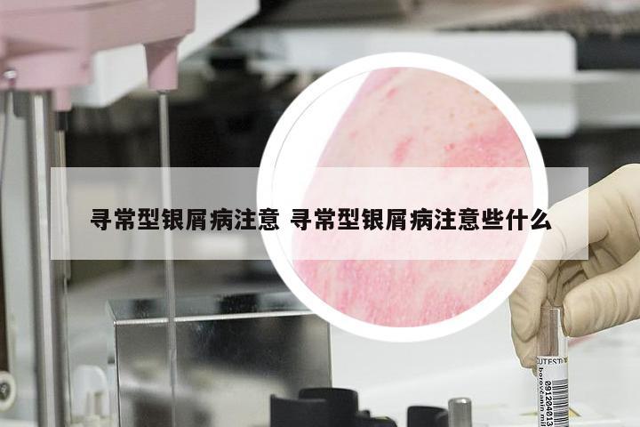 寻常型银屑病注意 寻常型银屑病注意些什么