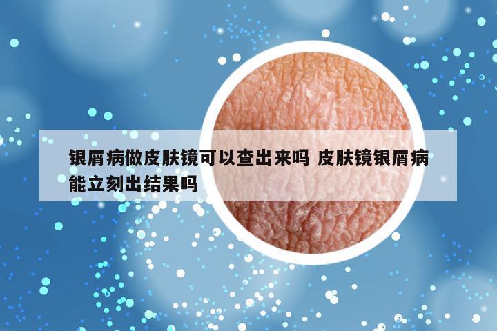 银屑病做皮肤镜可以查出来吗 皮肤镜银屑病能立刻出结果吗
