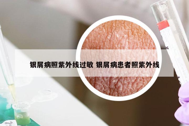 银屑病照紫外线过敏 银屑病患者照紫外线