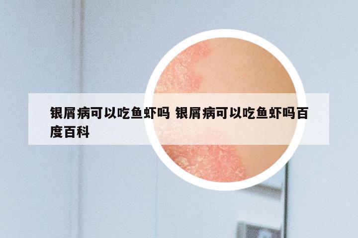 银屑病可以吃鱼虾吗 银屑病可以吃鱼虾吗百度百科