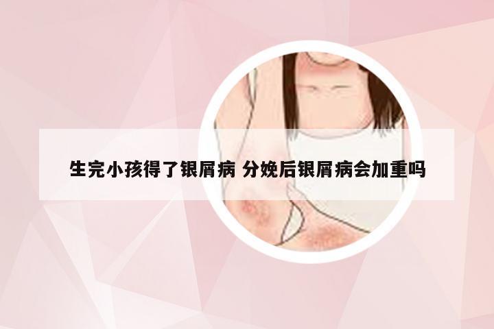 生完小孩得了银屑病 分娩后银屑病会加重吗