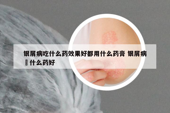 银屑病吃什么药效果好都用什么药膏 银屑病抺什么药好