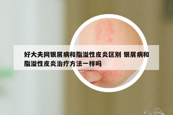 好大夫网银屑病和脂溢性皮炎区别 银屑病和脂溢性皮炎治疗方法一样吗