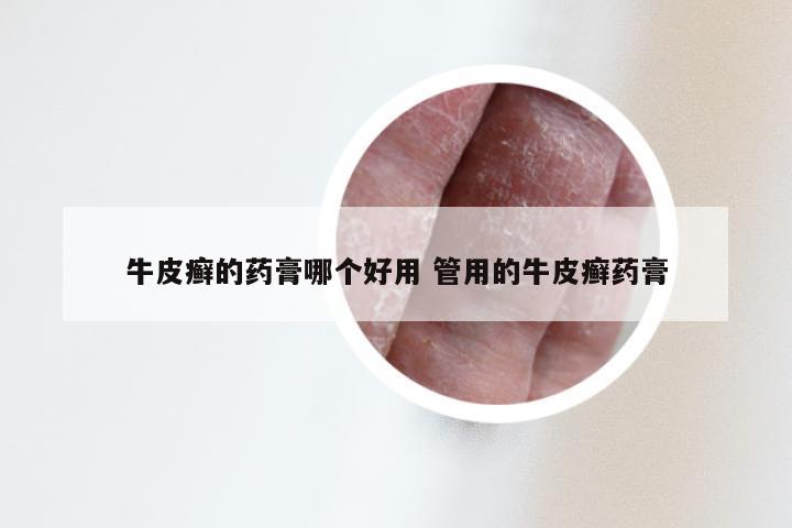 牛皮癣的药膏哪个好用 管用的牛皮癣药膏