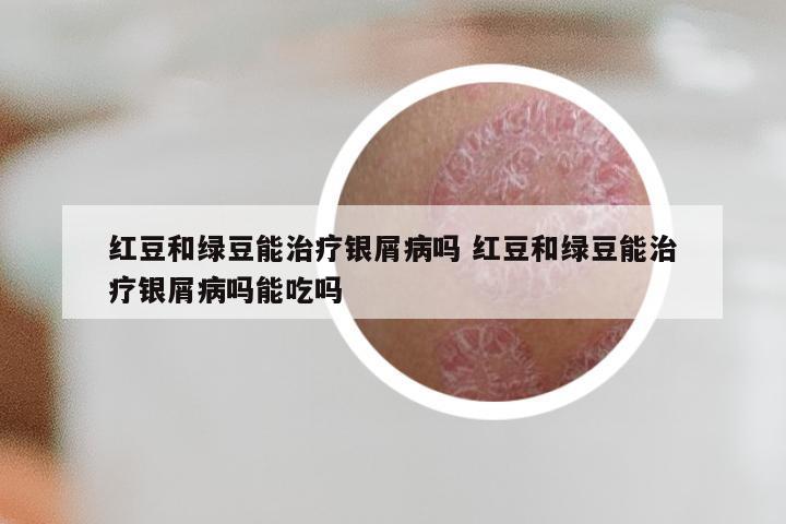 红豆和绿豆能治疗银屑病吗 红豆和绿豆能治疗银屑病吗能吃吗