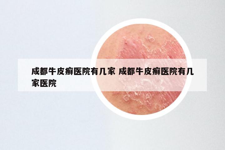 成都牛皮癣医院有几家 成都牛皮癣医院有几家医院