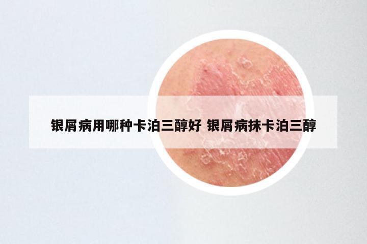 银屑病用哪种卡泊三醇好 银屑病抹卡泊三醇