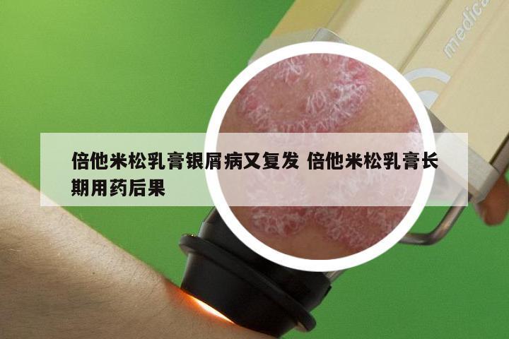 倍他米松乳膏银屑病又复发 倍他米松乳膏长期用药后果