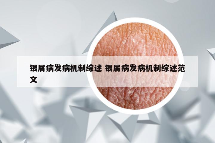 银屑病发病机制综述 银屑病发病机制综述范文