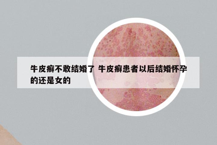 牛皮癣不敢结婚了 牛皮癣患者以后结婚怀孕的还是女的