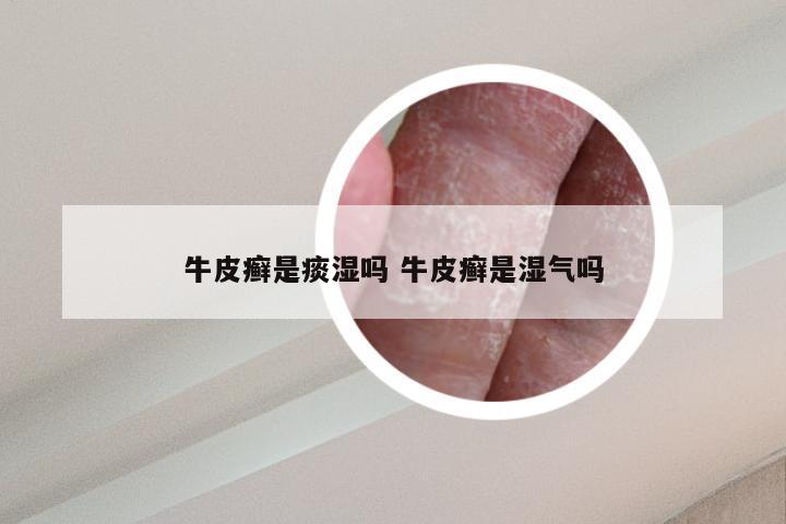 牛皮癣是痰湿吗 牛皮癣是湿气吗