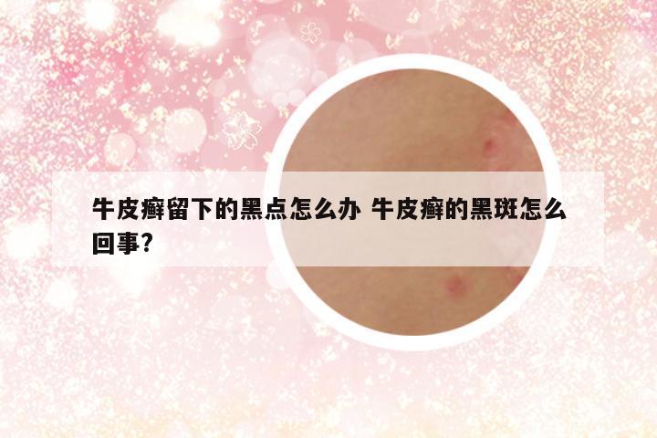 牛皮癣留下的黑点怎么办 牛皮癣的黑斑怎么回事?