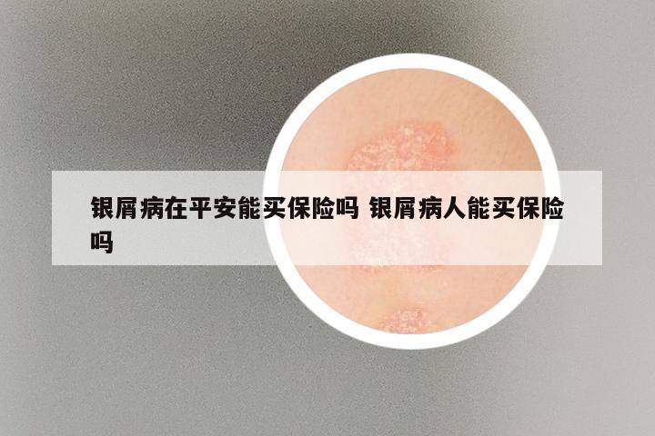 银屑病在平安能买保险吗 银屑病人能买保险吗