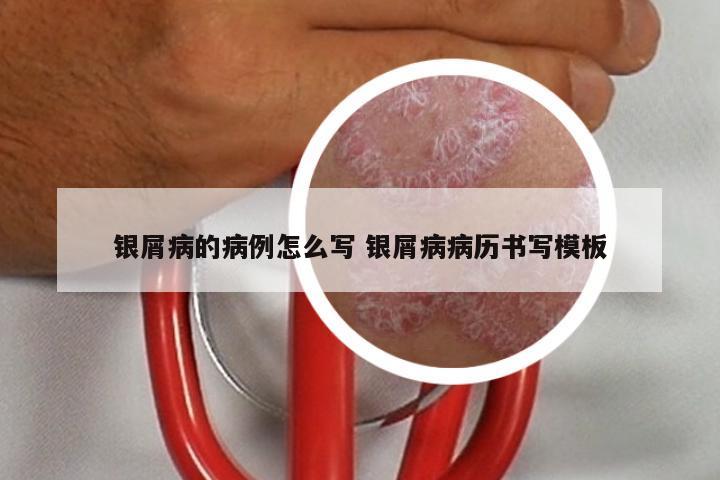 银屑病的病例怎么写 银屑病病历书写模板