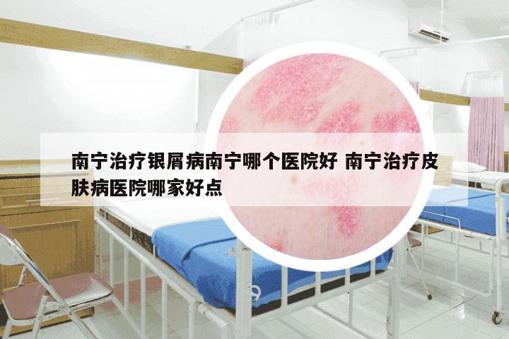 南宁治疗银屑病南宁哪个医院好 南宁治疗皮肤病医院哪家好点
